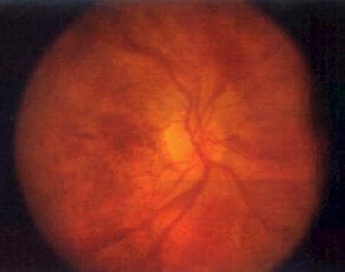 Patient with nonischemic central retinal vein occl