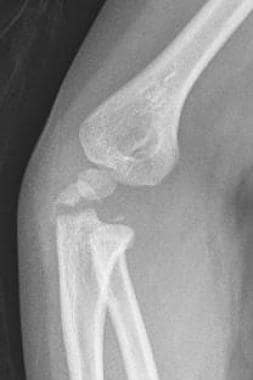 olecranon avulsion fracture