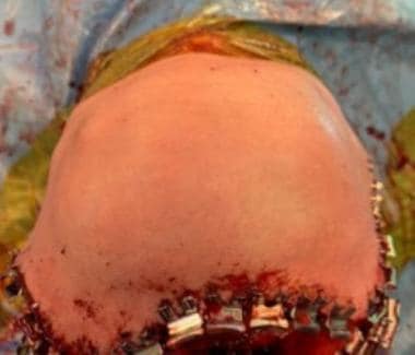 Intraoperative top-down view of same patient with 