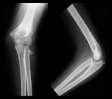 Radial head fracture in a child. 