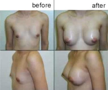 Breast augmentation, subglandular. Very small A cu