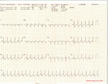 Coronary Artery Atherosclerosis. Stress test, part