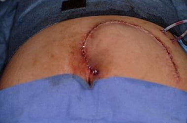 Small sacral pressure ulcer reconstructed with inf