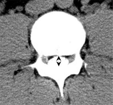 Lumbar computed tomography (CT) myelogram scan dem