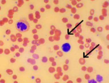 hemolytic disease of the newborn blood smear