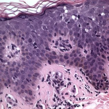 mycosis fungoides histology