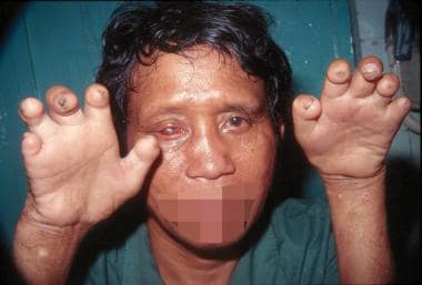Man with advanced deformities caused by unmanaged 
