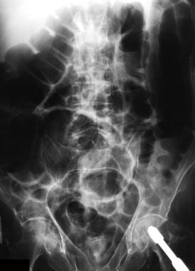 Post-Operative Ileus - TeachMeSurgery