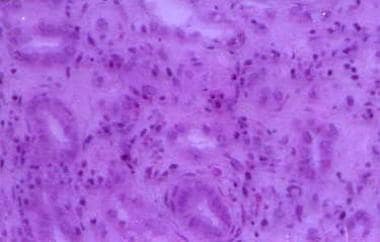 Mononuclear cell infiltrate between tubules. 