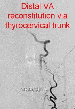 vertebral artery test sitting