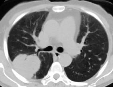 Contrast-enhanced chest CT scan showing poorly def