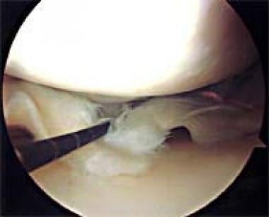 Arthroscopic probing of a posterior horn complex m