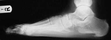 Lateral radiograph of foot reveals calcaneal spur 
