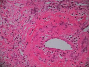 Lung biopsy specimen from a patient with granuloma