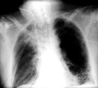 This chest radiograph performed 24 hours following