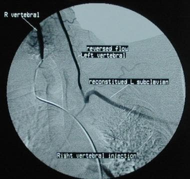 Retrograde blood flow from left vertebral artery i