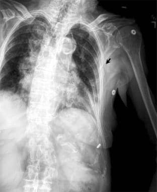 Anterior ribcage for points of fracture/fixation and displacement