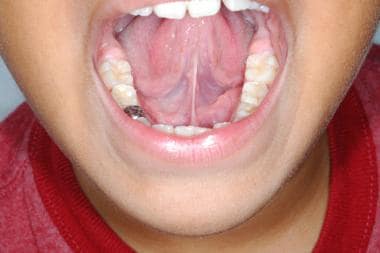 sublingual caruncle swelling