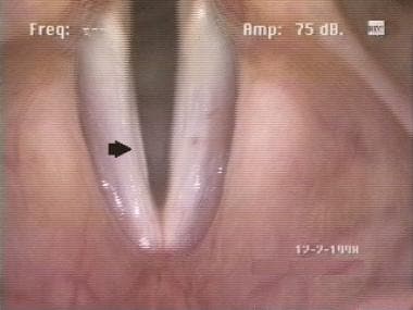 Linear sulcus nearly the length of the true vocal 