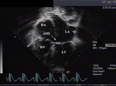Apical echocardiographic view of a primum atrial s