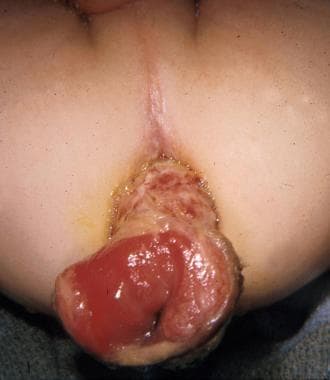 Picture of infant with full-thickness rectal prola