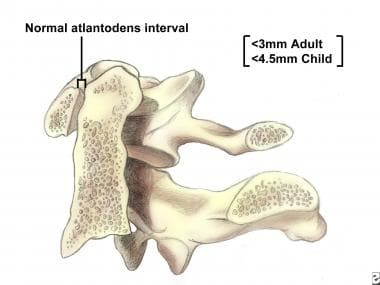 atlantoaxial instability