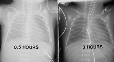 Chest radiographs in a premature infant with respi