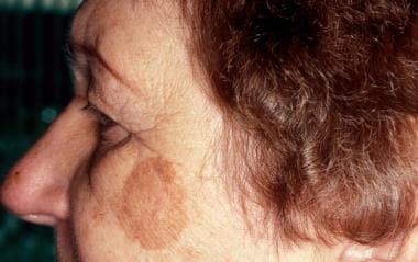 Fractional Laser (CO2 laser) and Melasma: An Additional Treatment Option