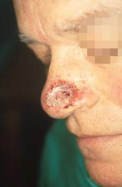 Expression of the hematoma in this patient did not