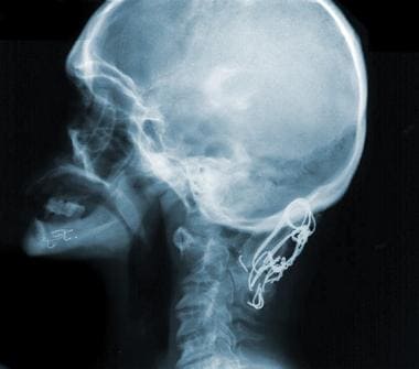 一位患有唐氏综合症的女性颈椎侧位片