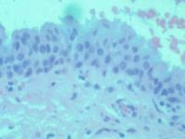 Histologic findings of invasive melanoma cells may