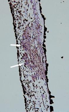 Histopathologic section of a Lisch nodule showing 