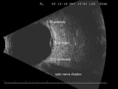 Longitudinal scan of the same choroidal melanoma. 