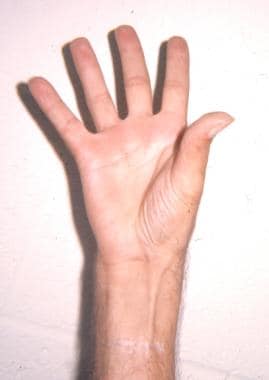 Postoperative photo of a hand following a Camitz a