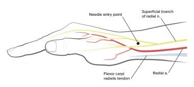 Radial nerve block at the wrist level. 