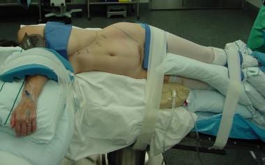 Laparoscopic splenectomy. Patient positioning for 