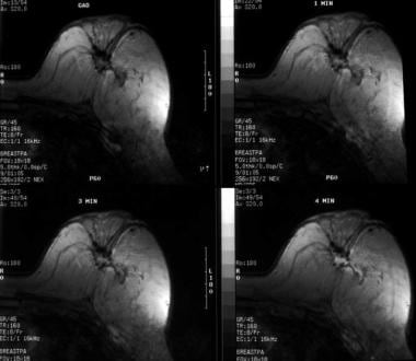 Breast Magnetic Resonance Imaging (MRI)