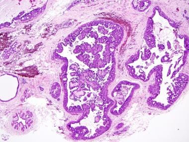 Mammográfiás emlőrák-szűrés esetdemonstráció, Papilloma dcis-sel