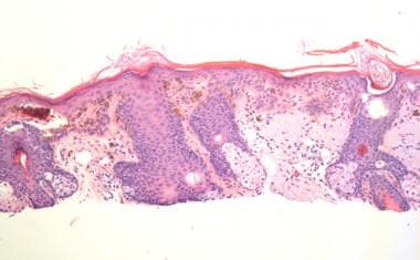 Acantholysis is present in this actinic keratosis.