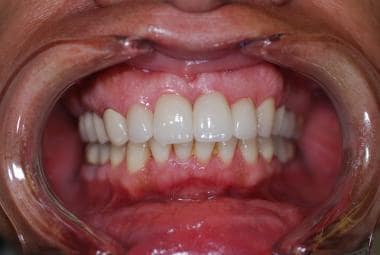 Postoperative view of a diastema closure. 