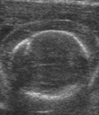 Fetal hydrops. Ultrasound image of scalp edema in 