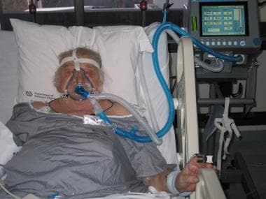 ventilator mask icu