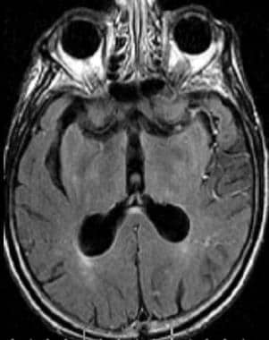 Axial FLAIR image demonstrates intra-arterial high