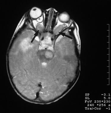 A 7-year-old girl with a family history of NF1 had