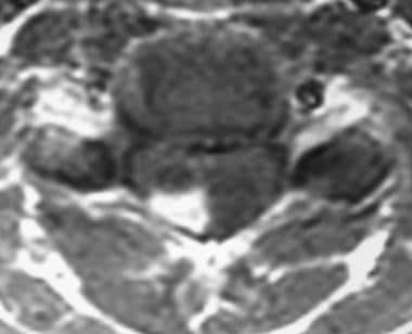 Axial T1-weighted image confirms the dorsal hemang