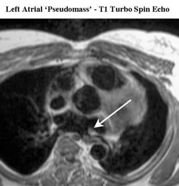 Axial T1-weighted turbo spin-echo MRI scan of a pa
