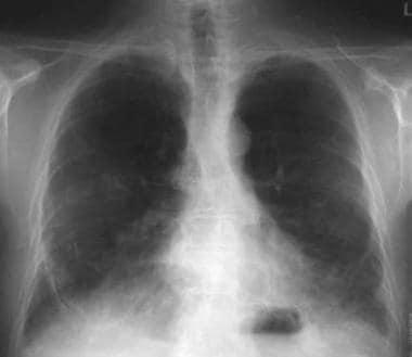 Asbestosis Imaging: Practice Essentials, Radiography, Computed Tomography