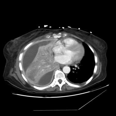 Image obtained in a patient with an empyema shows 
