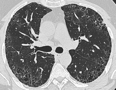 HRCT of advanced stage of pulmonary fibrosis demon
