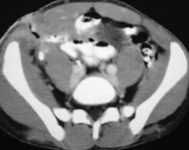 Crohn disease. Enterocutaneous fistula. CT scan de